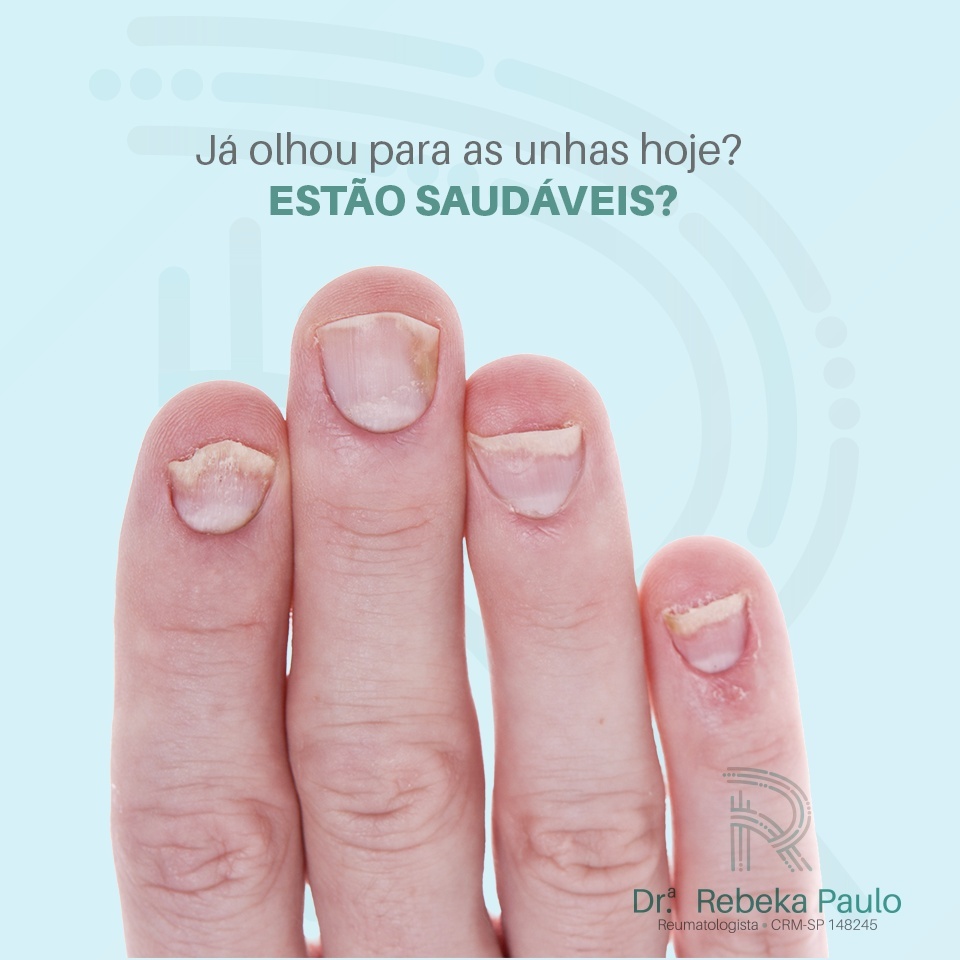 Já olhou para suas unhas hoje? Estão saudáveis?