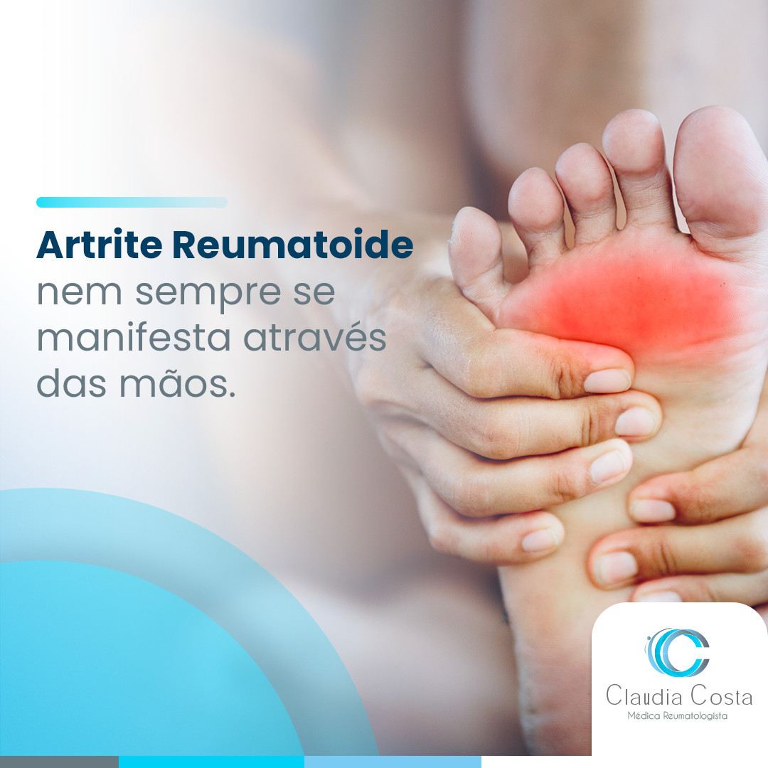 Artrite reumatoide nem sempre se manifesta através das mãos
