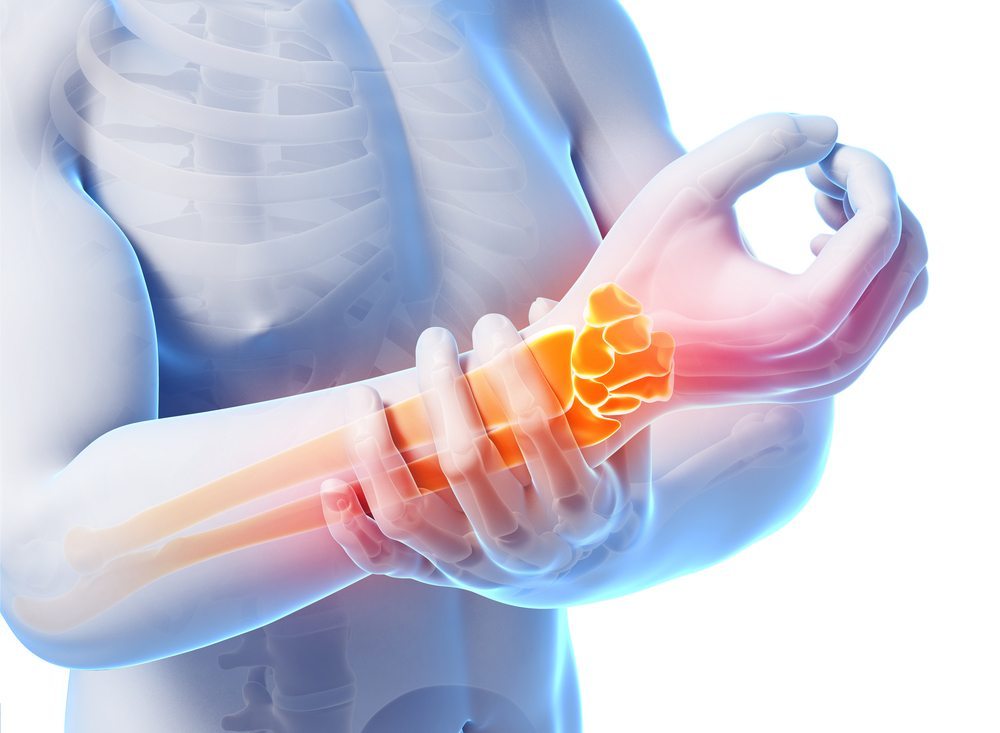 Dores na mão? Pode ser a Síndrome do Túnel do Carpo