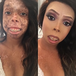 Jovem com doença rara ficou 2 anos reclusa, mas amigos a ajudaram a superar