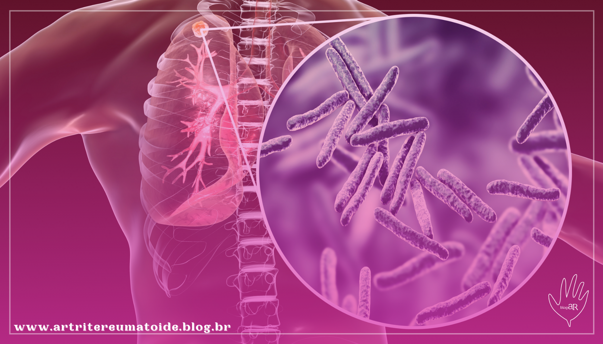 Dia Mundial de Combate à Tuberculose