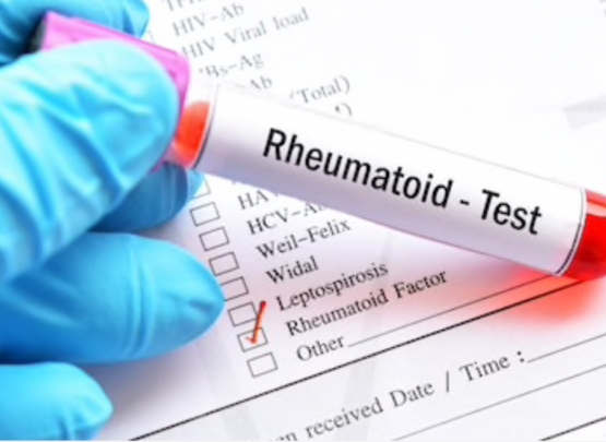 Se o fator reumatoide vier positivo, significa que tenho artrite reumatoide?