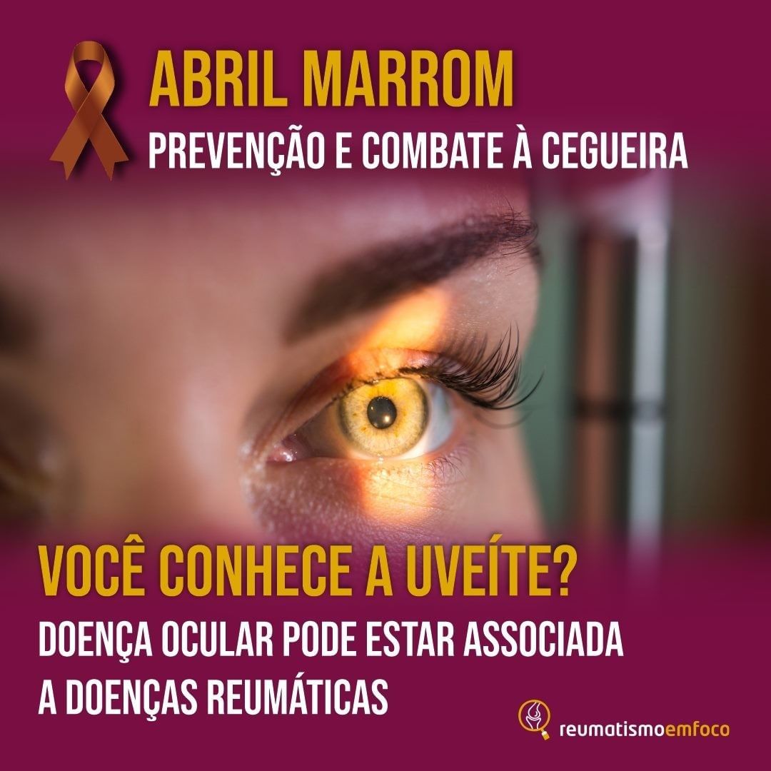 Você conhece a uveíte? Doença ocular pode estar associada a doenças reumáticas