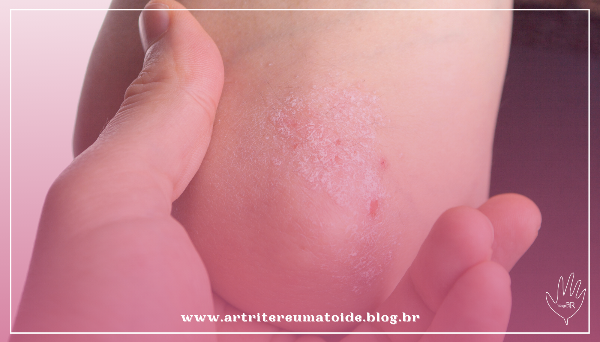 Consulta pública analisa a incorporação de medicamento para o tratamento de Artrite Psoriásica em primeira linha de tratamento biológico