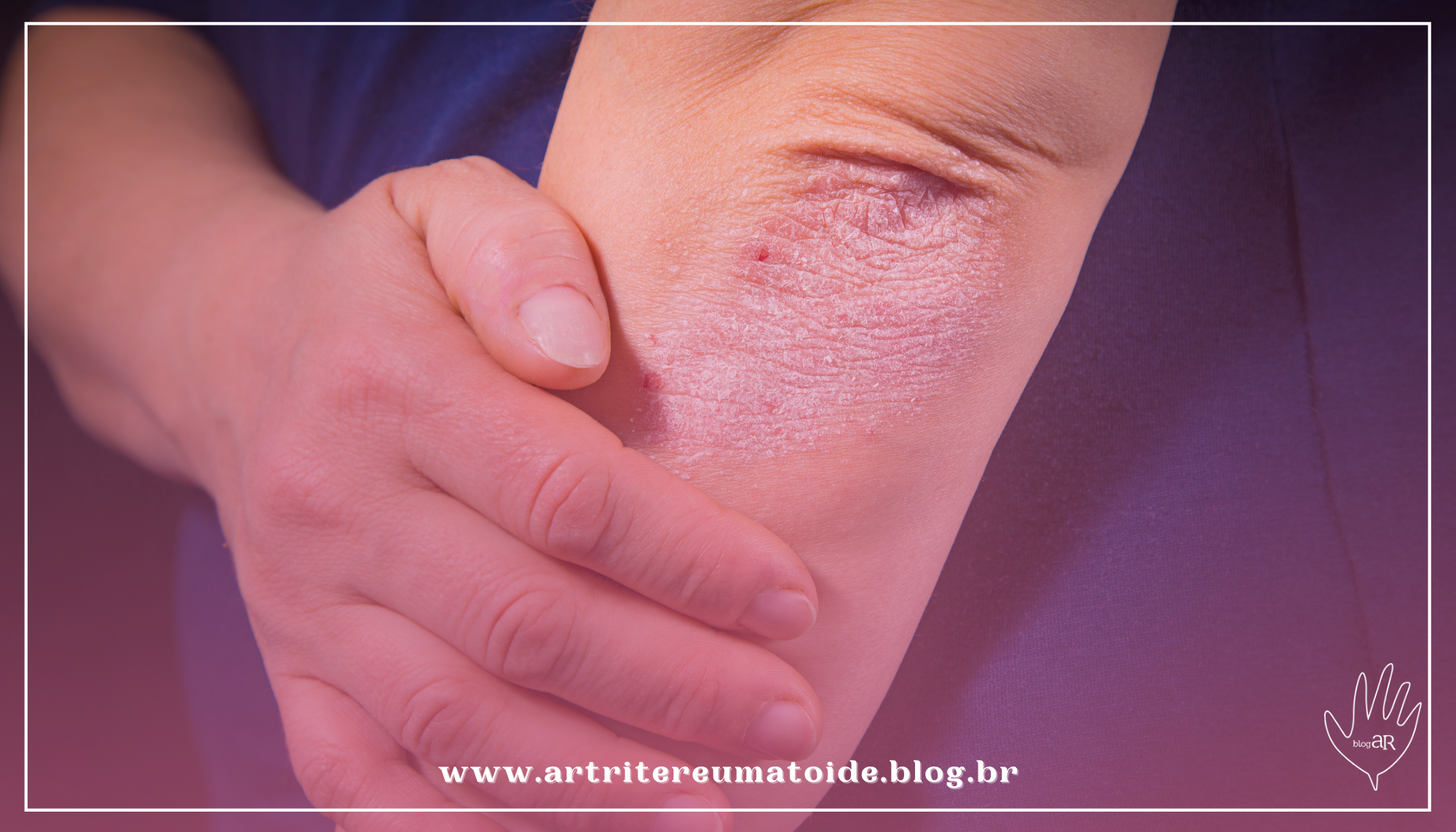 Consulta pública analisa a incorporação de medicamento para o tratamento de pacientes com psoríase em placas moderada a grave