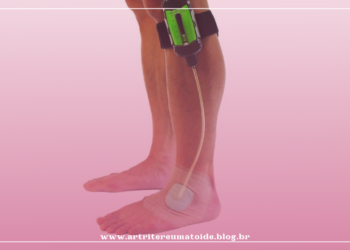 ANS aprova procedimento de Terapia por Pressão Negativa para úlceras de pé em diabéticos no Rol de Cobertura Mínima de Procedimentos e Eventos em Saúde