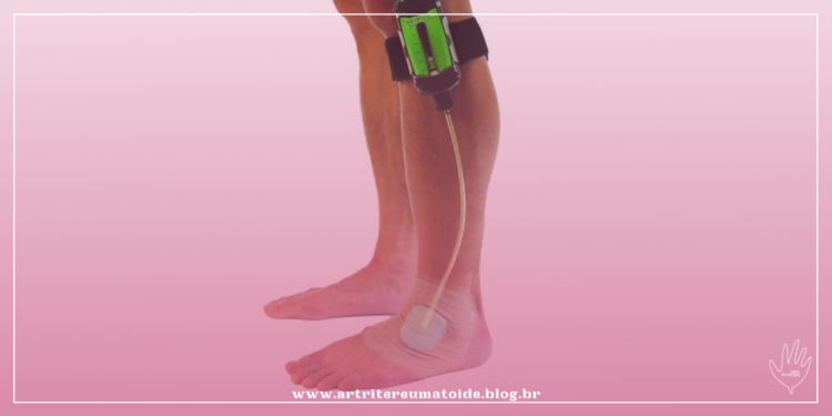 ANS aprova procedimento de Terapia por Pressão Negativa para úlceras de pé em diabéticos no Rol de Cobertura Mínima de Procedimentos e Eventos em Saúde