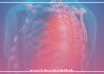 Espondilite anquilosante: 5 curiosidades sobre a doença