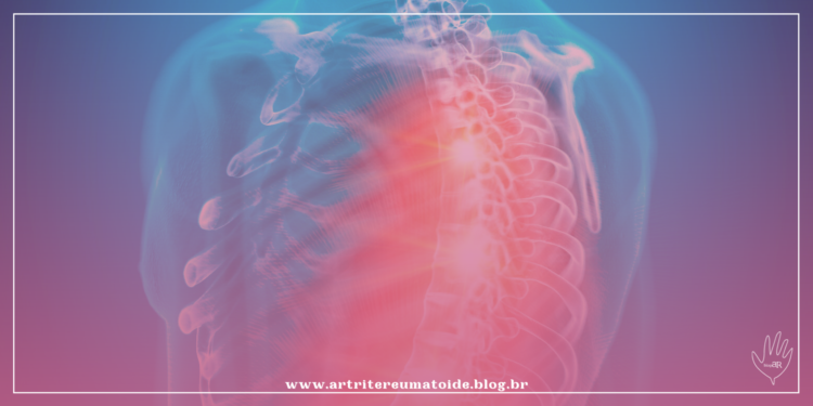 Espondilite anquilosante: 5 curiosidades sobre a doença