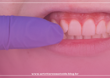 Bactérias da boca podem causar artrite reumatoide, indica estudo holandês