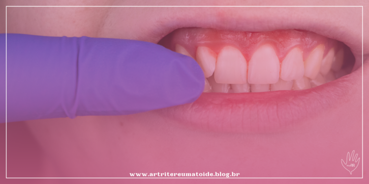 Bactérias da boca podem causar artrite reumatoide, indica estudo holandês