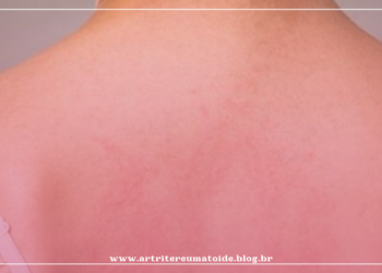 Você sabe o que é Lúpus?