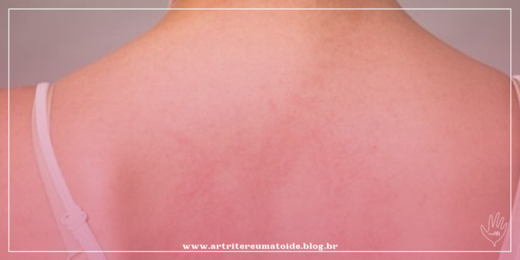 Você sabe o que é Lúpus?