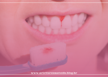 Periodontite, a inflamação que estraga o sorriso