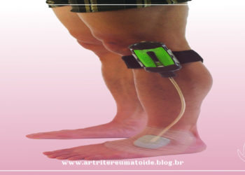 Terapia de Pressão Negativa para Feridas do Pé Diabético tem cobertura obrigatória no plano de saúde