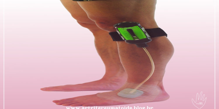 Terapia de Pressão Negativa para Feridas do Pé Diabético tem cobertura obrigatória no plano de saúde