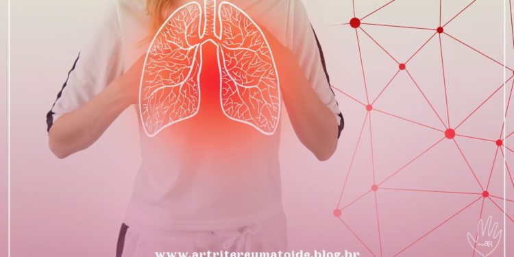 Saiba o que é a síndrome pós-covid e como o reumatologista pode contribuir para o seu controle