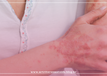 Conheça a psoríase, doença que deixou feridas em mais de 50% do corpo de Kelly Key