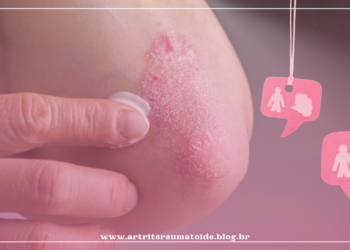 Proposta de atualização de protocolo da Psoríase está em consulta pública