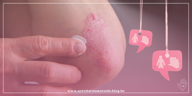 Proposta de atualização de protocolo da Psoríase está em consulta pública