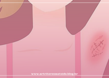 Novas coberturas no plano de saúde: Inclusão do Adalimumabe para o tratamento da hidradenite supurativa