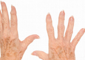 Nozinhos dolorosos nos dedos? Veja o que pode ser!