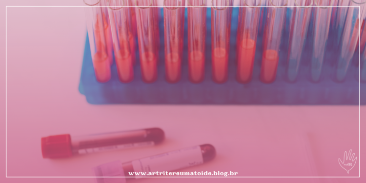 Sintomas da fibromialgia são consequência da ação de anticorpos do próprio paciente