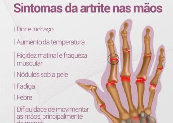 Sintomas da artrite nas mãos