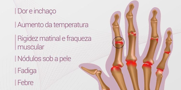 Sintomas da artrite nas mãos