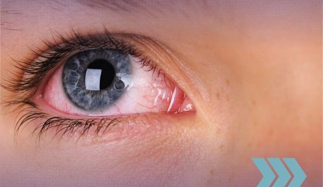 Você já ouviu falar da síndrome de Sjögren?