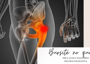 Bursite no quadril