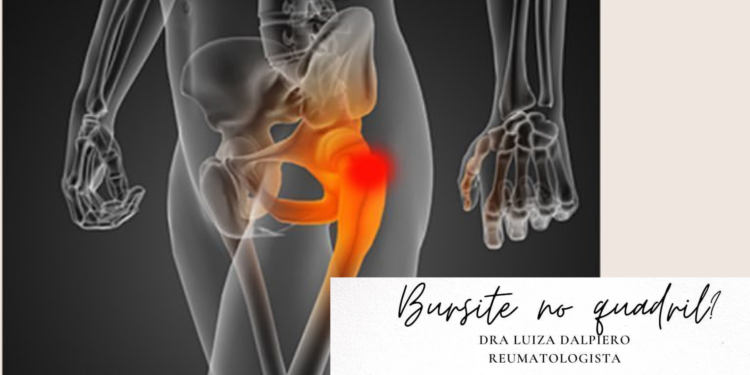 Bursite no quadril