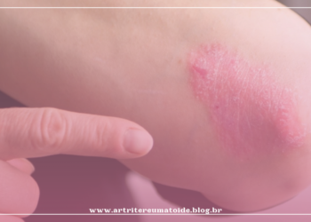 Estudo associa a psoríase e artrite psoriática à calcificação das artérias coronárias