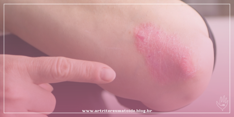 Estudo associa a psoríase e artrite psoriática à calcificação das artérias coronárias