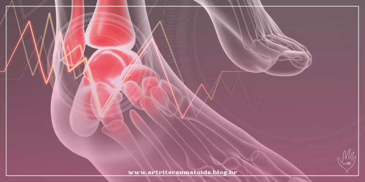 Em cirurgia inédita em Minas, paciente recebe prótese no tornozelo esquerdo