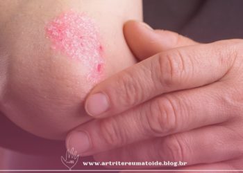 Associação entre a qualidade de vida e incapacidade em pessoas vivendo com psoríase