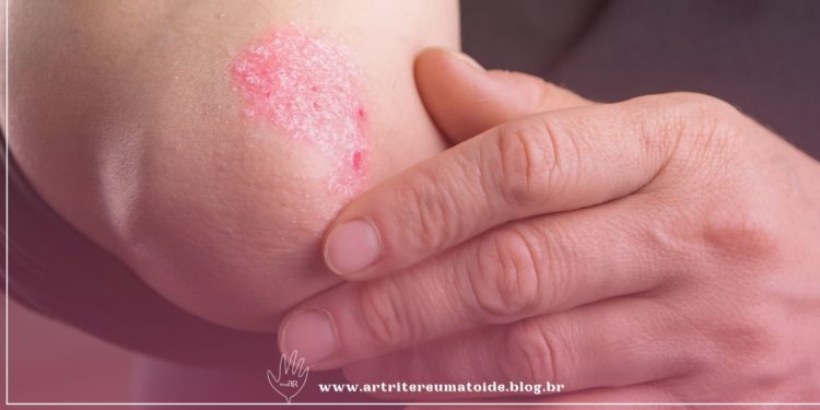 Associação entre a qualidade de vida e incapacidade em pessoas vivendo com psoríase