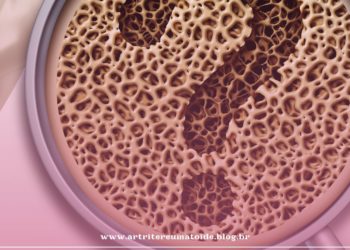 Dor nos ossos: conheça as 8 causas mais comuns