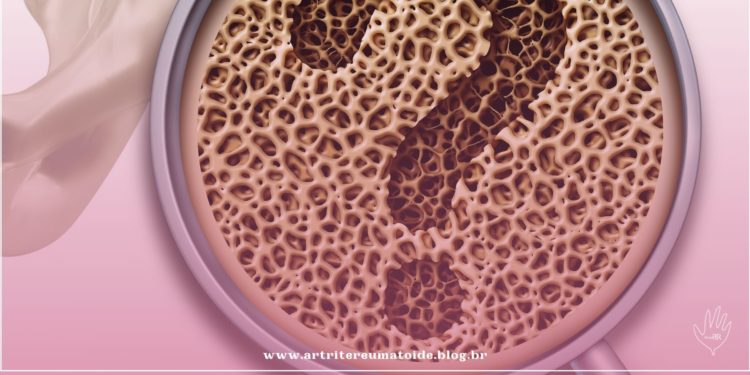 Dor nos ossos: conheça as 8 causas mais comuns