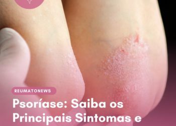 Psoríase: Saiba os Principais Sintomas e Tratamentos