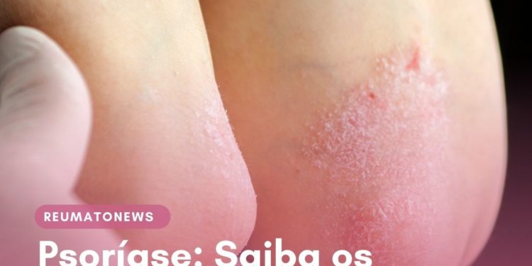 Psoríase: Saiba os Principais Sintomas e Tratamentos