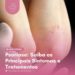 Psoríase: Saiba os Principais Sintomas e Tratamentos