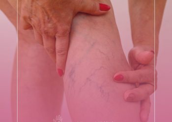 Porque eu tenho varizes nas pernas?