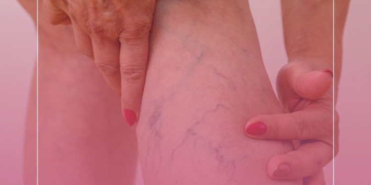 Porque eu tenho varizes nas pernas?