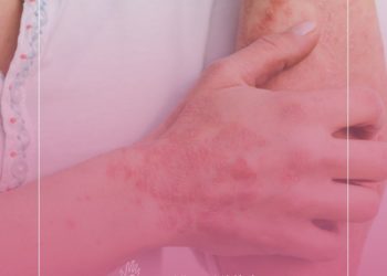 Kelly Key faz alerta sobre a psoríase, uma doença de pele que afeta a vida de milhões de brasileiros