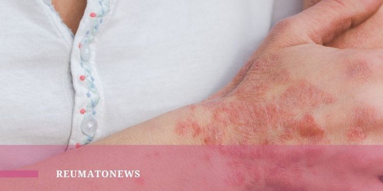 Dia Mundial da Psoríase – Bahiana Saúde