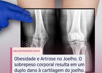 Obesidade Artrose no Joelho