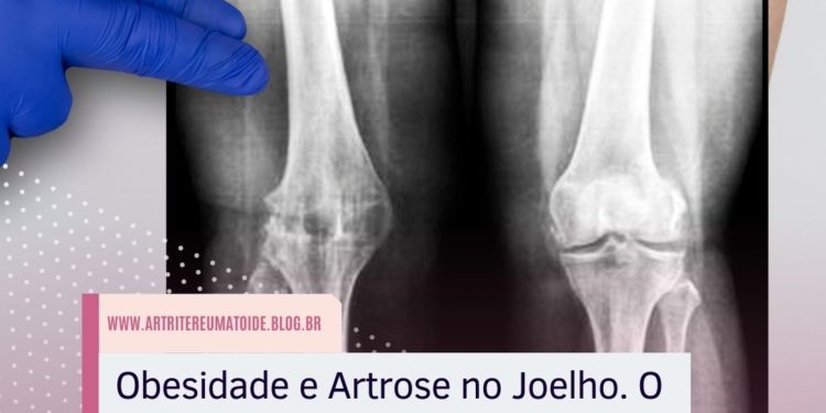 Obesidade Artrose no Joelho