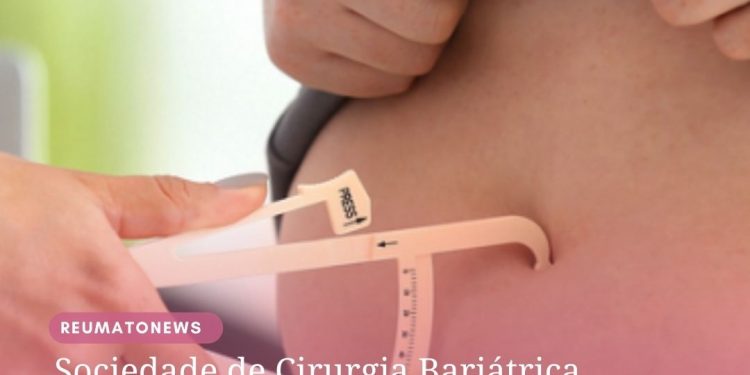 Sociedade de Cirurgia Bariátrica defende transparência na fila dos pacientes que aguardam cirurgia pelo SUS