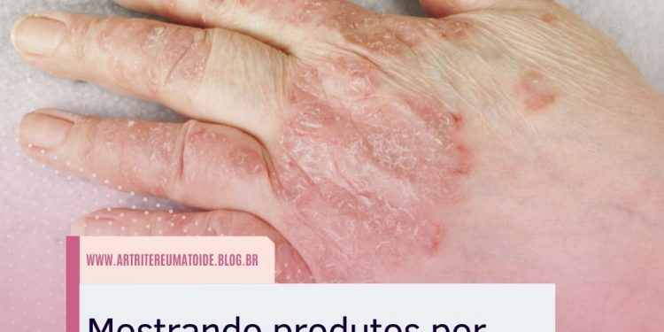 Mostrando produtos por etiqueta: artrite psoriásica